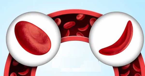 Anemia Profile